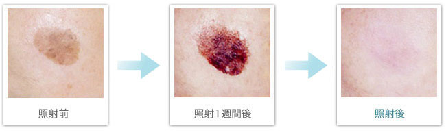 Qスイッチ付きルビーレーザー使用前後写真